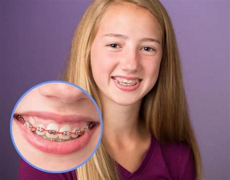 Colorful Teeth Braces Ideas Be Irresistible And Make A Fashion