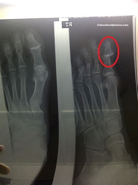 Dislocated Big Toe Treatment At Sunway Medical Centre Parantos