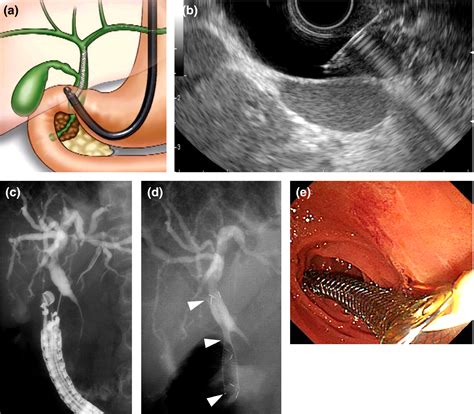 Pdf Endoscopic Ultrasound Guided Drainage Of Postoperative Intra