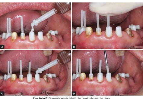 Pre Endodontic Post And Core Technique For Endodontic And Prosthodontic