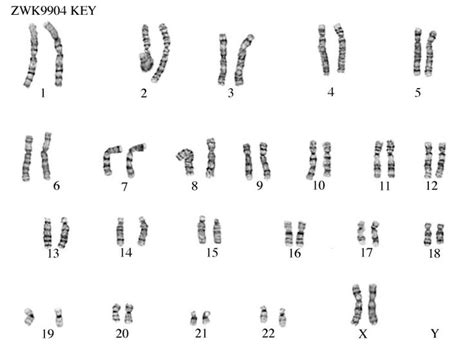 Karyotype A Diagram Of A Person S Chromosomes Note Please Use This