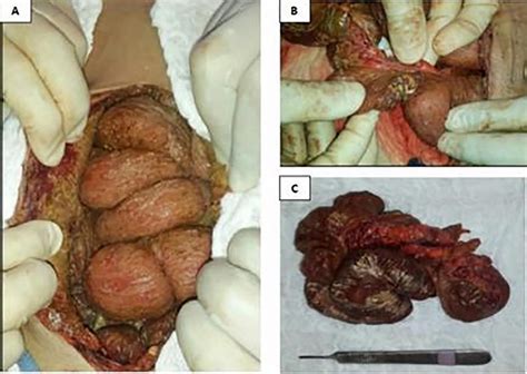 Encapsulating Peritoneal Sclerosis in a kidney transplant recipient