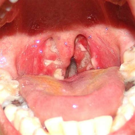 Pictures Of Acute Follicular Streptococcal Tonsillitis Strep Throat
