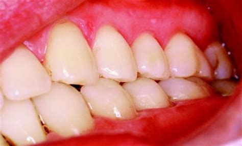 The group function occlusion on working side distributes the occlusal load and prevents teeth on non working side from being subjected to the destructive, obliquely directed forces. 4: PRINCIPLES OF OCCLUSION | Pocket Dentistry