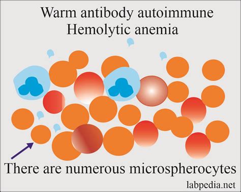 Chapter 27 Autoimmune Diseases Autoimmune Hemolytic Anemia Aha