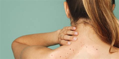 Remove Those Ugly Dark Patches On The Neck Underarms And Inner Thighs