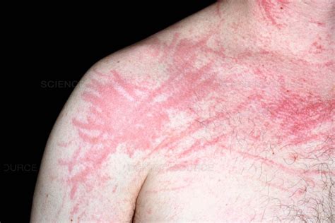 10 Free Tips On Dermatographic Urticaria Symptom And Causes