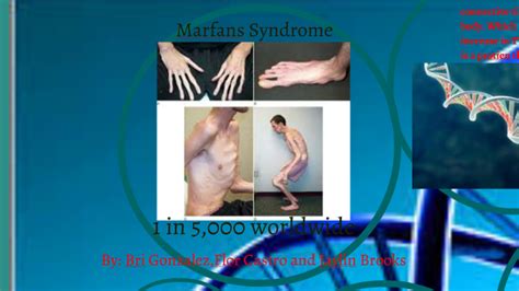 Marfans Syndrome By Bri Gonzalez