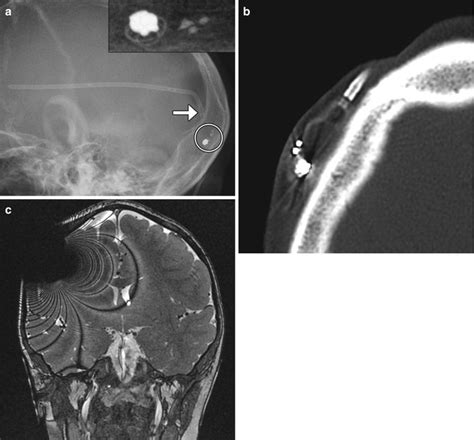 Imaging Of Cerebrospinal Fluid Shunts Drains And Diversion Techniques