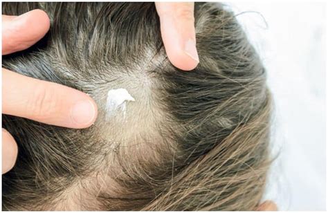 Hair Loss Spiritual Cause Meaning And Healing Insight State