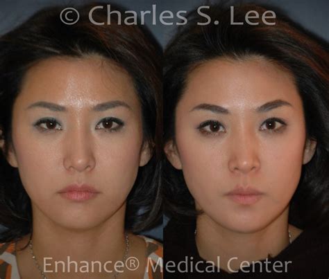 Non Surgical Browlift Midfacelift Lip Corner Lift Charles S Lee Md