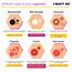 6 Different Types Of Acne Explained  Beauty Bay Edited