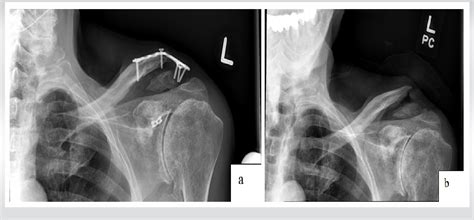 Figure 1 From Conversion Of Neer Type Ii Closed Distal Clavicle