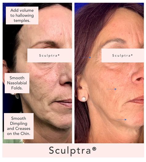 Sculptra Fairfield County Injectable Facial Fillers And Cheek Fillers