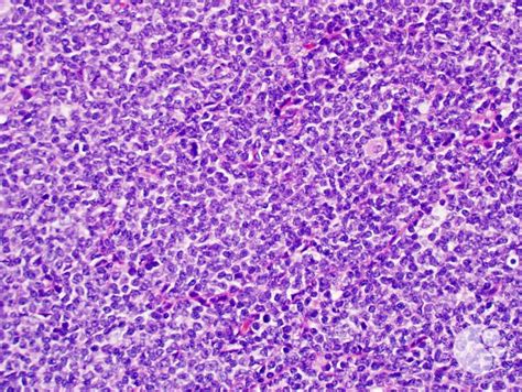 Mantle Cell Lymphoma 1
