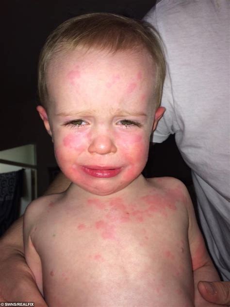 Baby With Scarlet Fever ‘turned Away From Hospital Three Times Real Fix