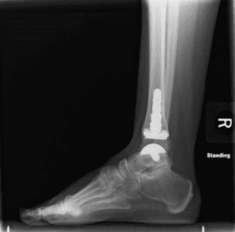Dallas Ankle Replacement Surgery Dallas Orthopedic Surgeon And Pt
