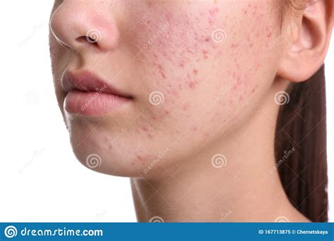 Teenage Girl With Acne Problem On White Background Stock Image Image