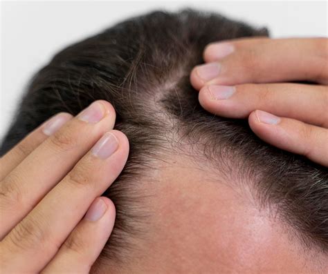 Causas De Alopecia Androgénica O Caída De Cabello En Hombres