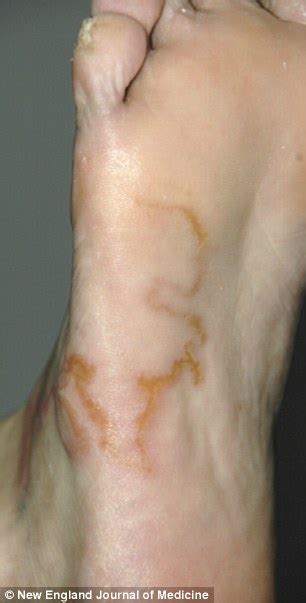 The Varicose Vein That Was Actually A Worm Daily Mail Online