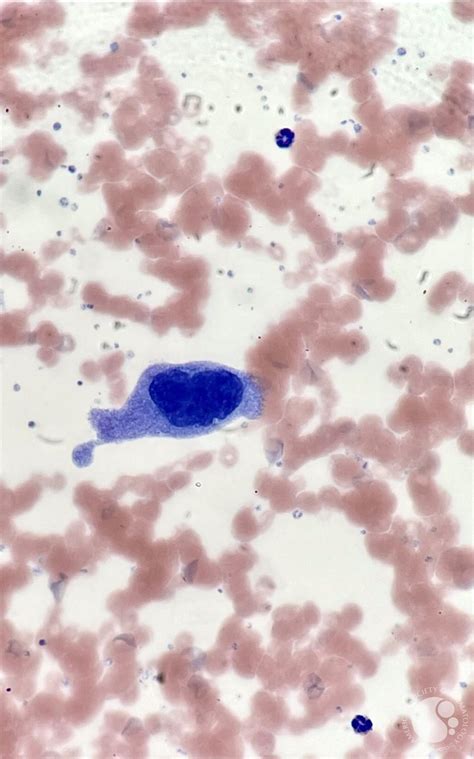 Circulating Megakaryocyte In Peripheral Blood Smear