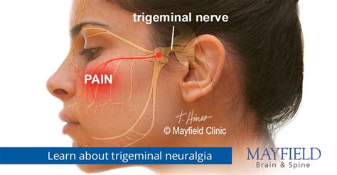 Facial Pain Trigeminal Neuralgia Cincinnati Oh Mayfield Brain And Spine