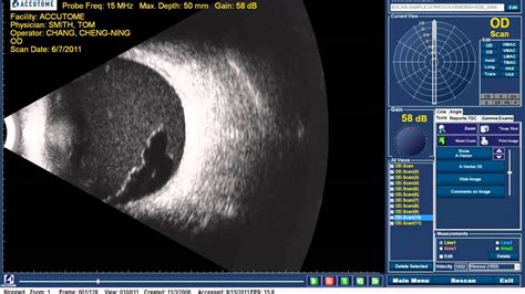 Every page goes through several hundred of perfecting techniques; Accutome B-scan Plus - Vitreous Hemorrhage - YouTube