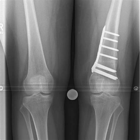Pdf Supracondylar Rotation Osteotomy Of The Femur Influences The