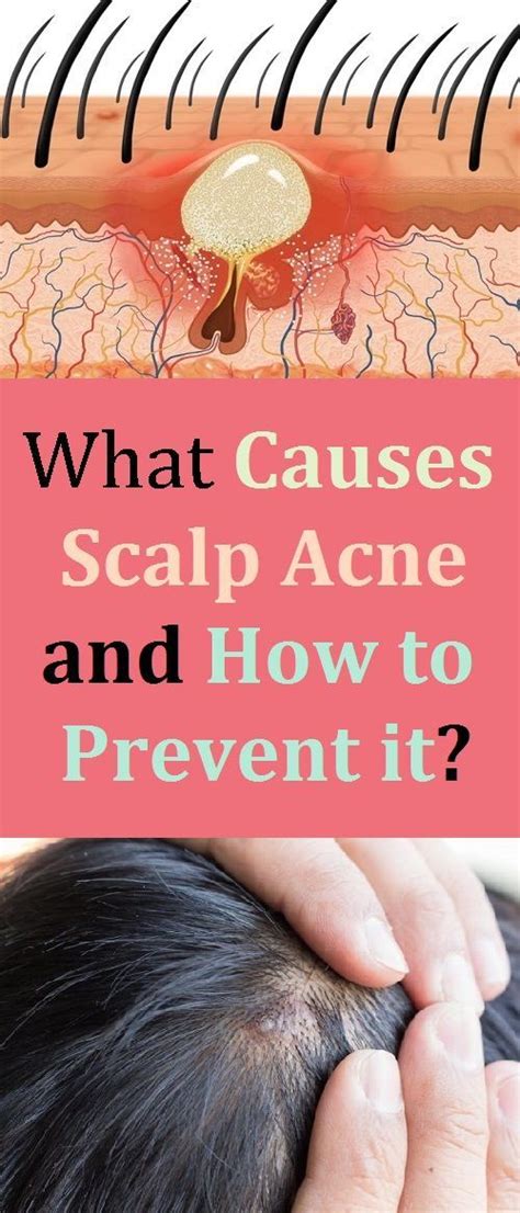 How To Treat Pimples On Scalp Howotremvo