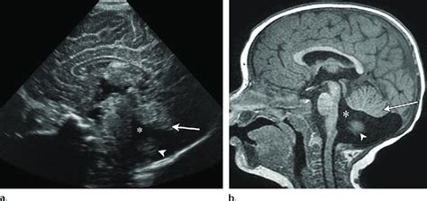 Dandy Walker Spectrum Malformation Of Moderate Severity In A Girl With