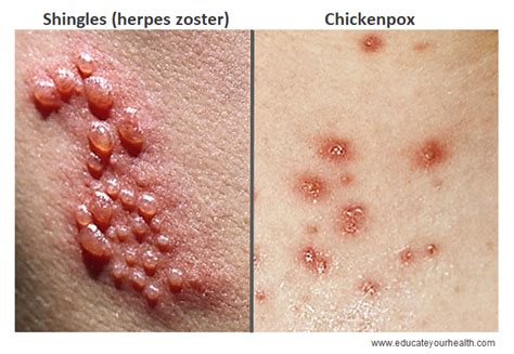 Shingles Herpes Zoster Educate Health