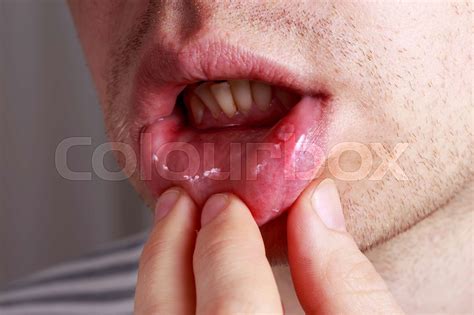 Stomatitis On The Lips Stock Image Colourbox