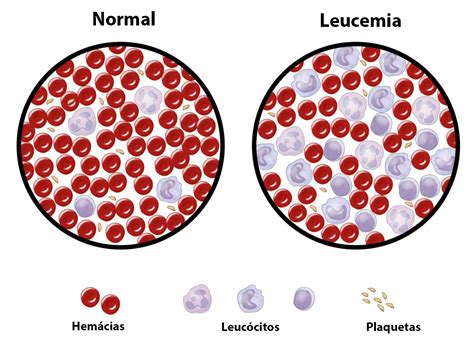 Leucemias Tipos Causas Sintomas Diagnóstico E Tratamento Ibap Ibap