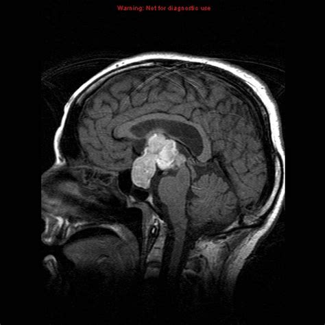 Growth Hormone Deficiency Mri Wikidoc