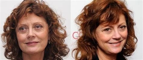 Free General Fashion Susan Sarandon Before And After Plastic Surgery