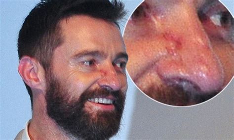 Hugh Jackman Reveals The True Extent Of Having Skin Cancer At X Men Singapore Premiere Daily