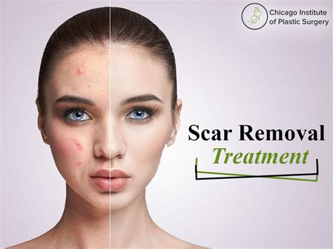 Best Treatments For The Removal Of Scar And Make Your Skin Smooth