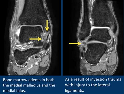 The Radiology Assistant Mri Examination Of The Ankle