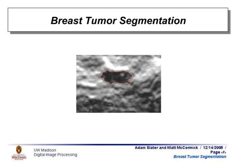 Ppt Breast Tumor Segmentation Powerpoint Presentation Free Download