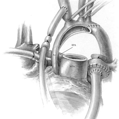 The Innominate Artery Was Snared Proximal To The Perfusion Site And