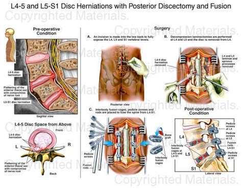 L4 5 And L5 S1 Disc Herniations With Posterior Discectomy And Fusion Disk Herniation