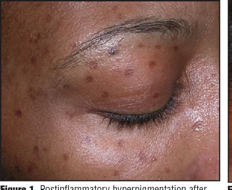Figure 4 From Postinflammatory Hyperpigmentation A Review Of The