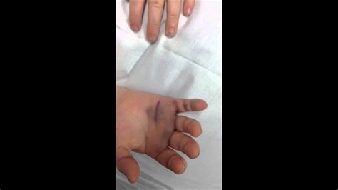 eilysh s hand broken fractured pinky youtube