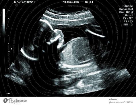 Ultraschallbild Des Babys Im Mutterleib Echographie Scan Ein