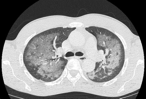 Image Of The Month All Puffed Out A Case Of Crack Lung Rcp Journals