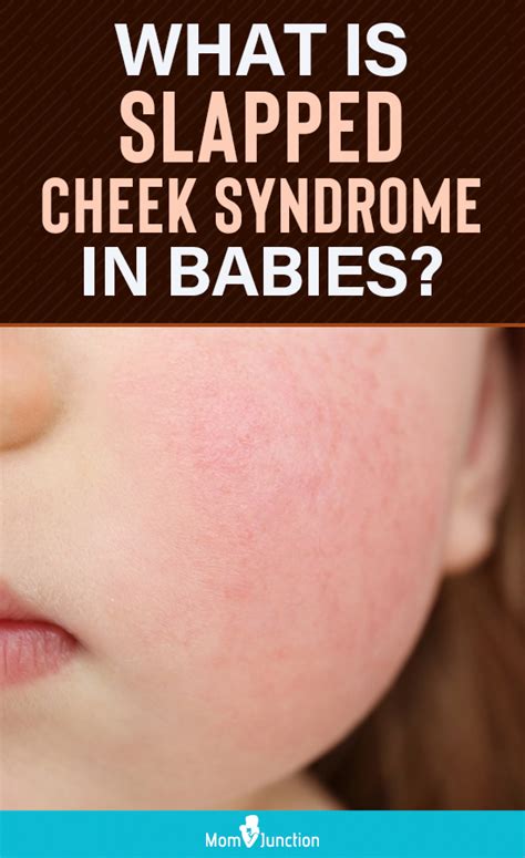 Slapped Cheek Syndrome Everything You Need To Know About The Condition