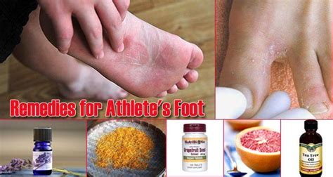17 Home Remedies For Athletes Foot Athletes Foot Home Remedies