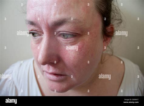 Woman With Severe Eczema Allergic Reaction On Face Model Released Stock