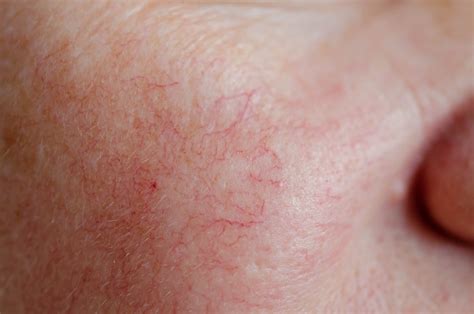 What Causes Spider Veins On Face And How To Treat Them Vein Center Doctor