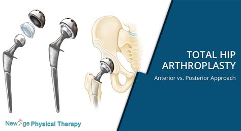 Total Hip Arthroplasty Anterior Vs Posterior Approach New Age